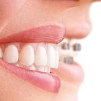Compared to braces