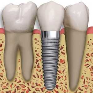 Image of Implants