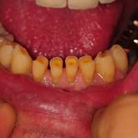 Worn front teeth