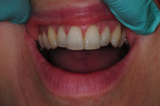Whitening