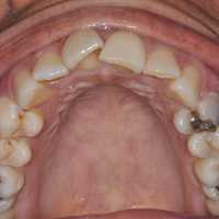 Upper teeth before