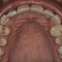 Upper teeth after