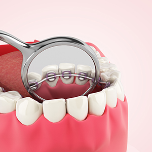 Image of Lingual braces
